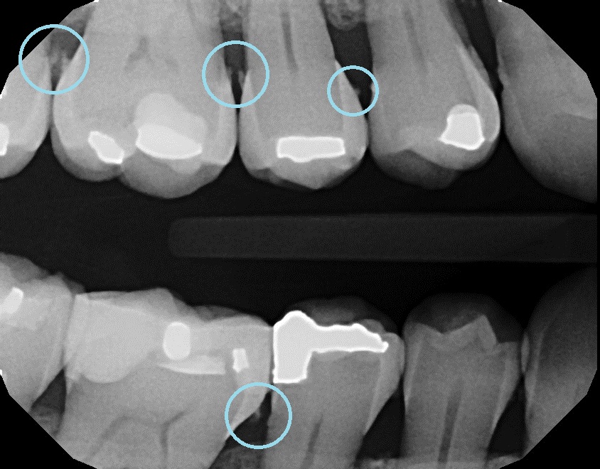 Dental Disease Detection